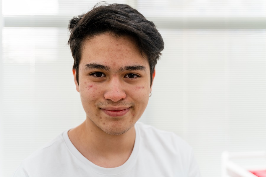 Teenaged boy with acne with dark hair smiles at the camera