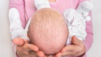 How to treat cradle cap