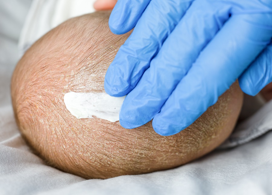 applying cream to baby's dry scalp with blue gloves